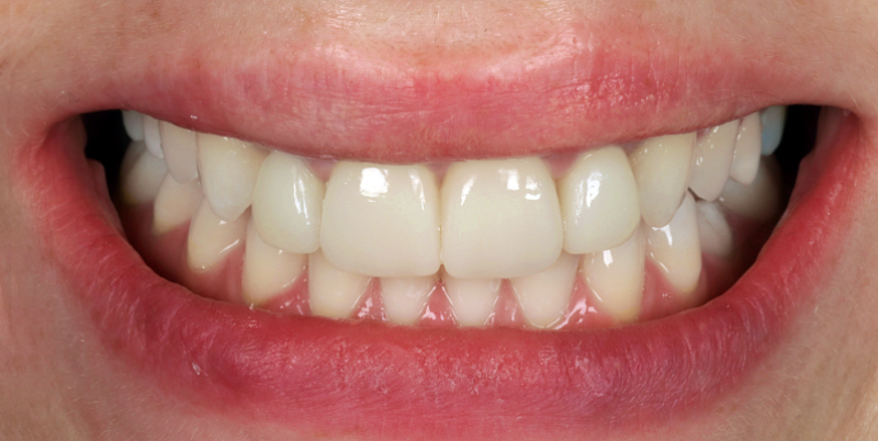 BracesVeneers A
