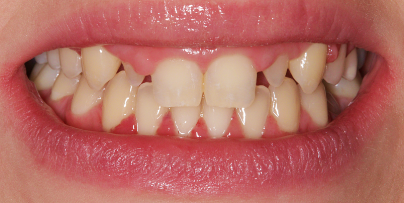 BracesVeneers B