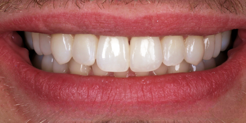 Case 1_Whitening+Composite Bonding A