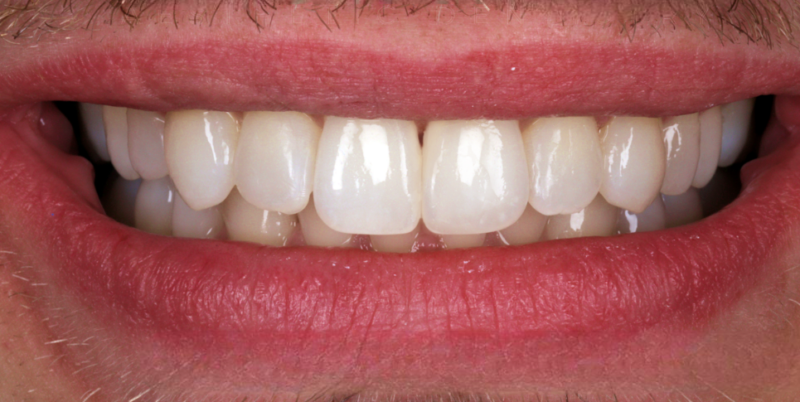 Case 1_Whitening+Composite Bonding A