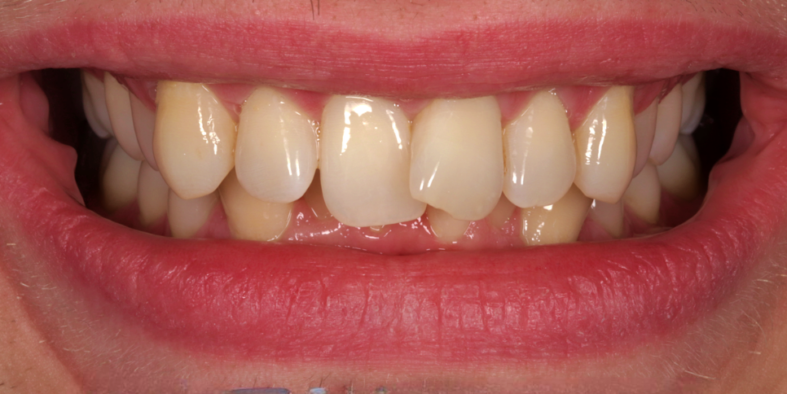 Case 1_Whitening+Composite Bonding B