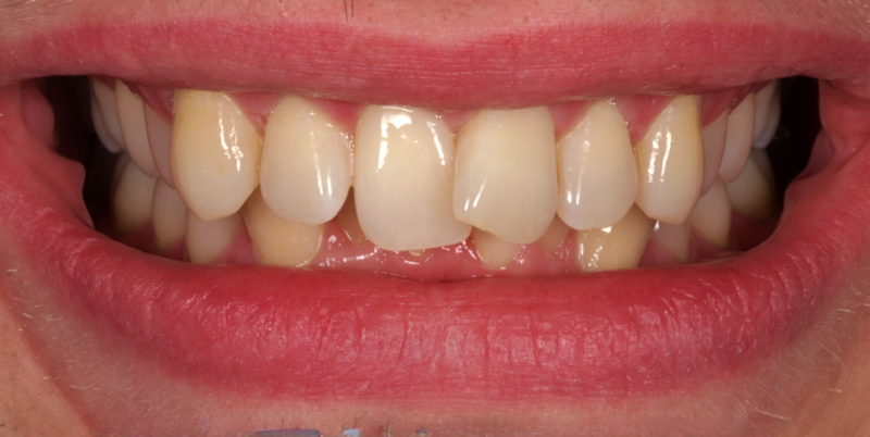 Case 1_Whitening+Composite Bonding B