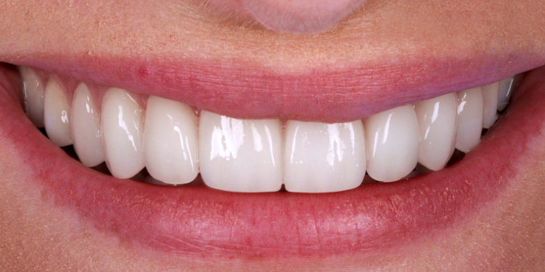 Porcelain Veneers A