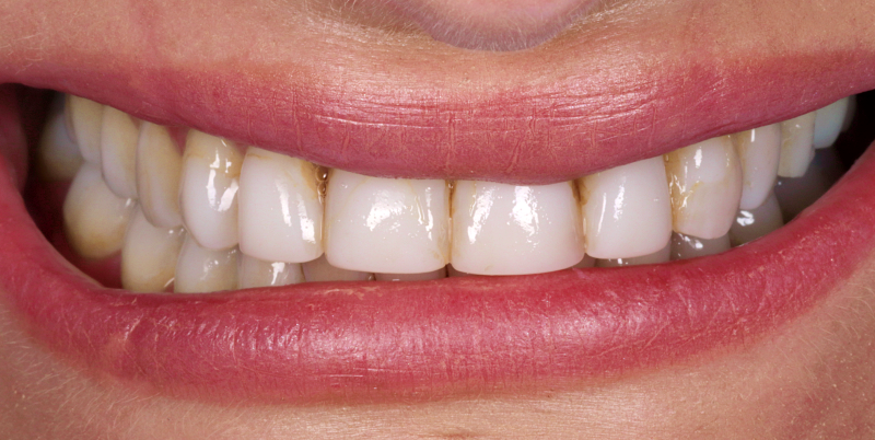 Porcelain Veneers B