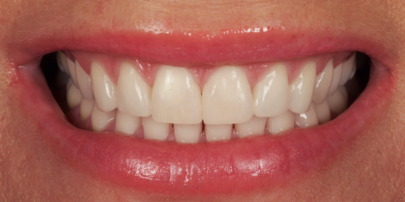 Whitening Composite bonding A
