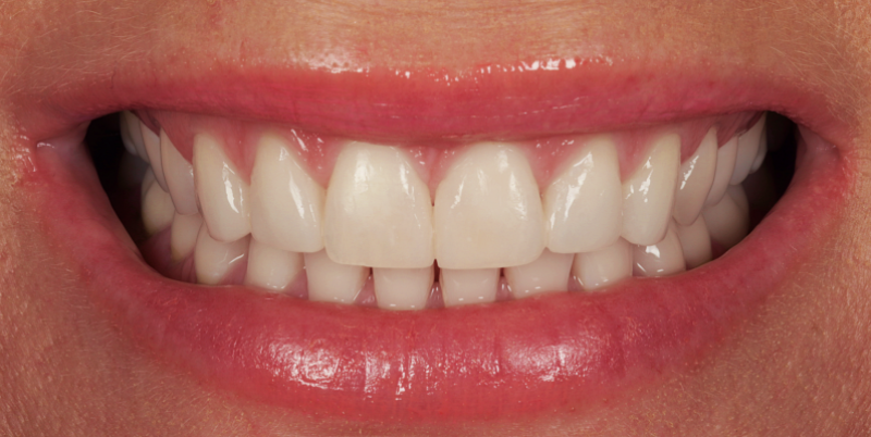 Whitening Composite bonding A