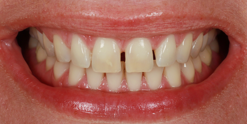 Whitening_Composite_bonding B