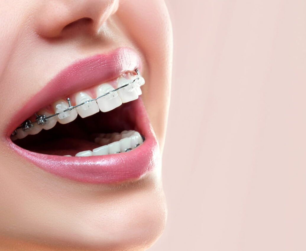 invisalign-banner