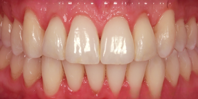 Case 3_Whitening A