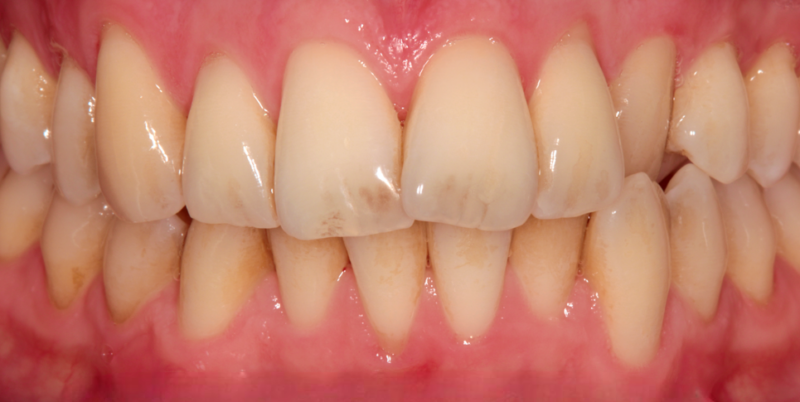 Case 3_Whitening B