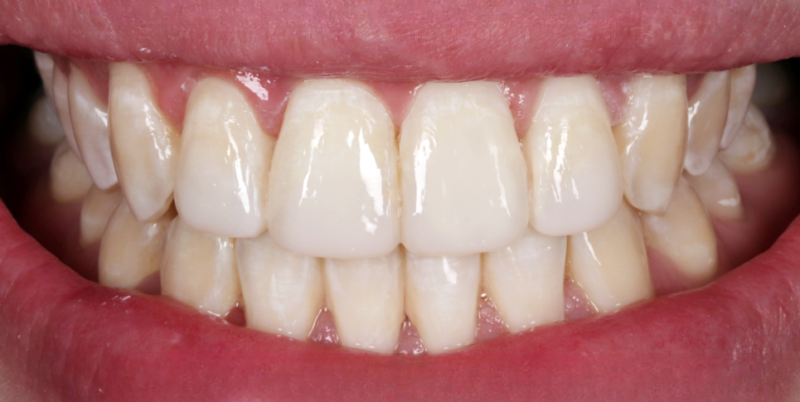 Case2_Whitening+Composite Bonding A