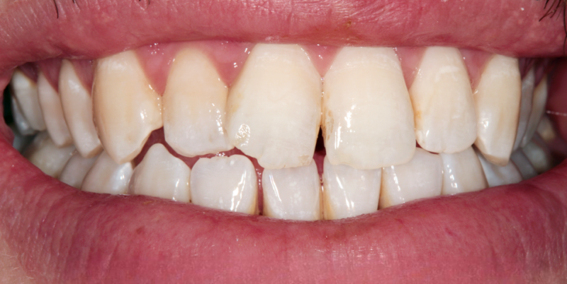 Case2_Whitening+Composite Bonding B