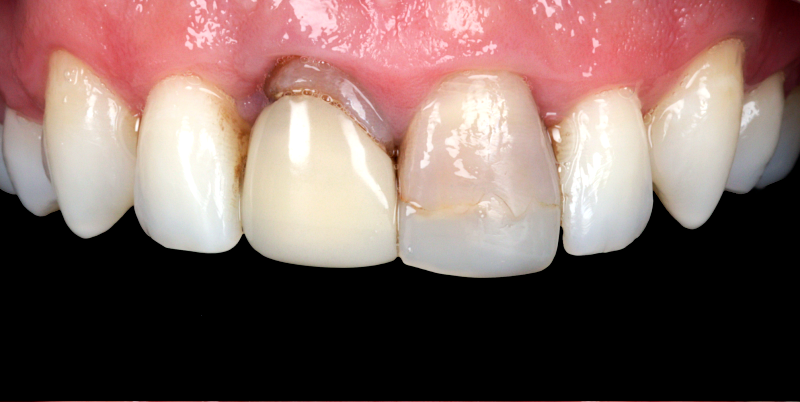 Before - Chatham Dental