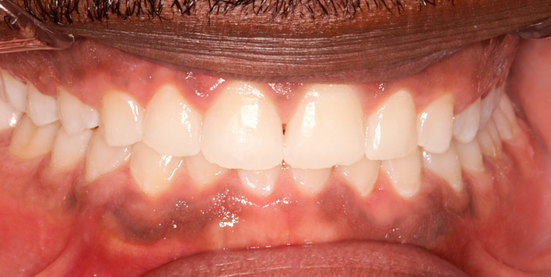 After -Chatham Dental